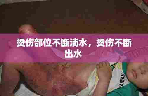 烫伤部位不断淌水,烫伤不断出水