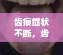 齿痕症状不断,齿痕严重吗