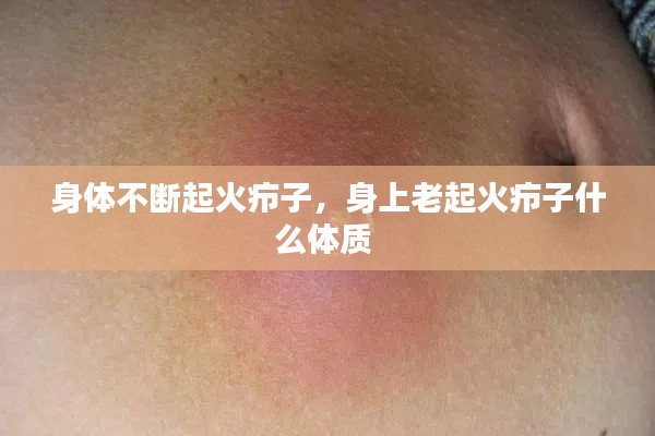 身体不断起火疖子,身上老起火疖子什么体质