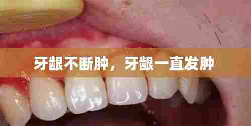 牙龈不断肿,牙龈一直发肿