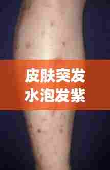 皮肤突发水泡发紫,皮肤紫色水泡