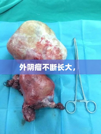 外阴瘤不断长大， 