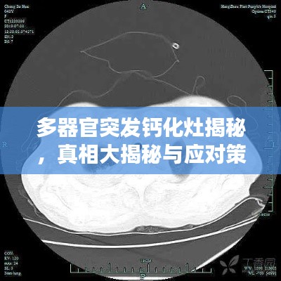 多器官突发钙化灶揭秘，真相大揭秘与应对策略！